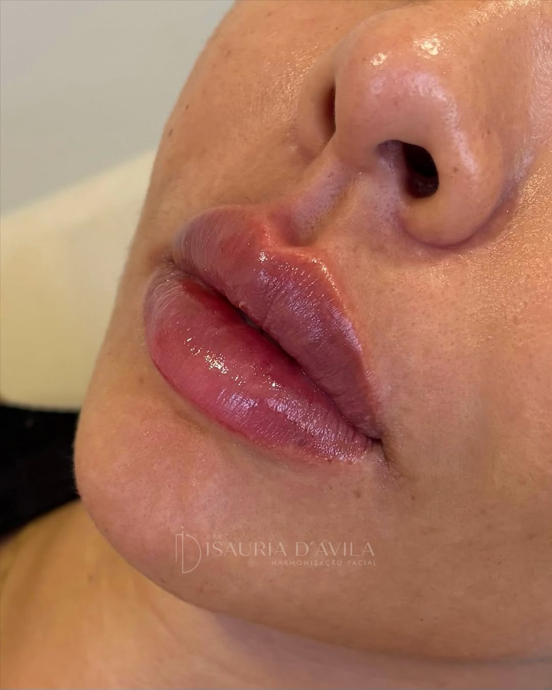 Preenchimento Labial — Depois